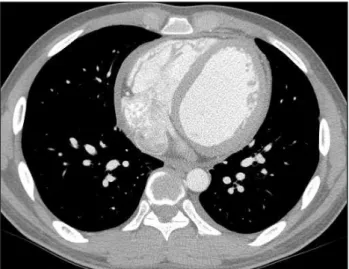 Fig. 2. Moderate amount of pericardial effusion with adhesion after 1  month of treatment with nonsteroidal anti-inflammatory drugs and  colchicines.
