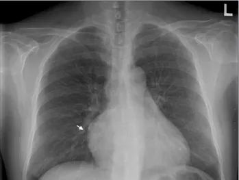 Fig. 1. Chest radiography showed prominent right heart border (arrow)  with mild cardiomegaly.