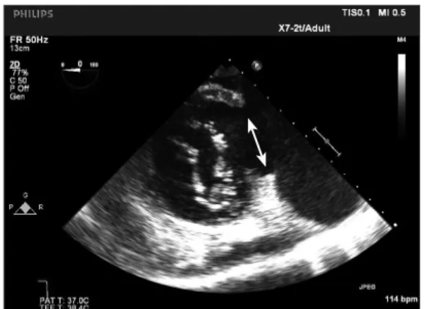 Fig.  2.  Transesophageal  echocardiography.  Three  dimensional  reconstruction as seen from within the pseudoaneurysm looking into  the left ventricle shows the extent of the rupture (see arrow)