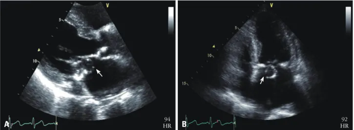 Fig. 1. A fluttering perforated cystic mass (1.3 × 1.6 cm, white arrow) in left atrium attached to the posterior mitral valve leaflet in the parasternal long  axis view (A) and apical 4 chamber view (B), which resulted in poor coaptation and opening of mit