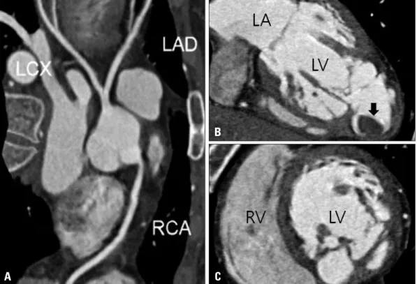 Fig. 4. Coronary computed tomography angiography, showing normal coronary artery (A), thrombus (arrow) in an apical  aneurysm (B), and a thick noncompacted layer (C)