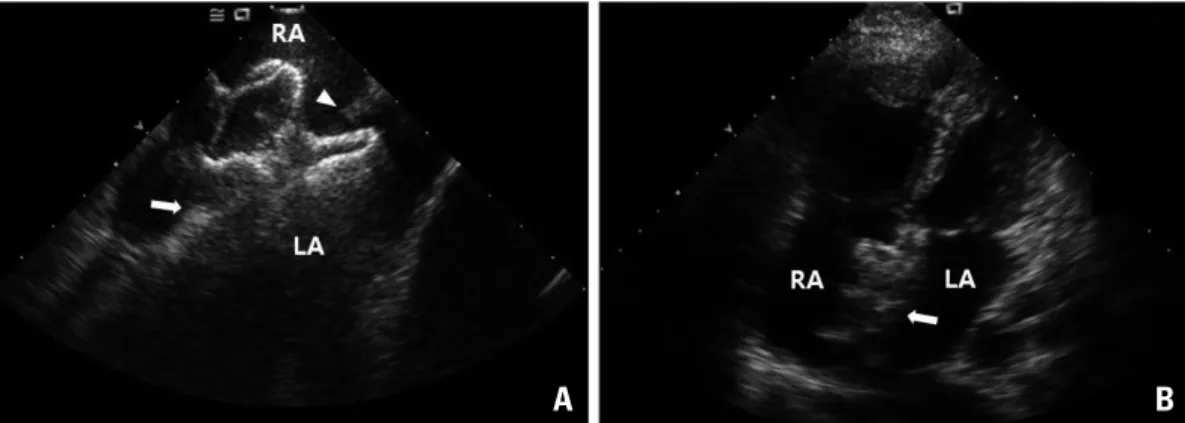 Fig. 2. Intracardiac echocardiographic still image during procedure (A). The Amplatzer device was successfully deployed  and its secure and stable position was confirmed by push-pull maneuver