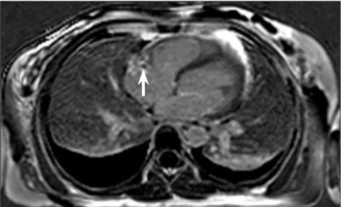 Fig. 2. Delayed enhancement images (DE-MRI) showed an 8 mm sized  thrombus (arrow) in the right atrium.