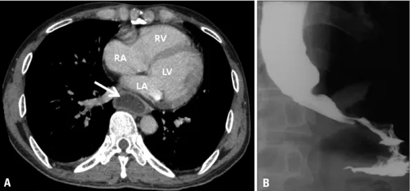 Fig. 2. A: Dilatation of the esophagus compressing the left atrium was revealed in chest computed tomography (white  arrow)
