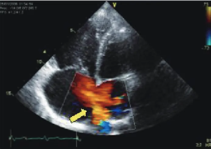 Fig. 3. Chest dynamic computed tomography showed right sided aortic arch (arrow).