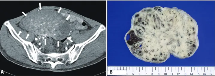 Fig. 3. Computed tomographic findings of carcinoid tumor. A large mass with inhomogenous density occupies the right pelvic cavity