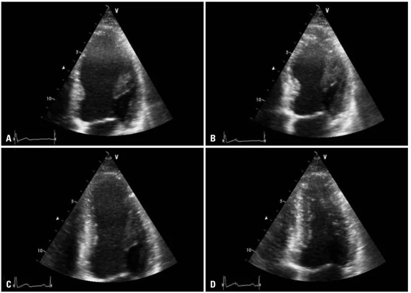 Fig. 1. An apical four-chamber view of the left ventricle in the emergency department is shown at end-diastole (A) and end-systole (B)