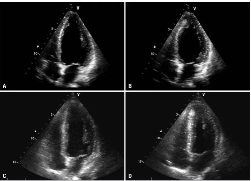Fig. 3. An apical four-chamber view of the left ventricle in the emergency department is shown at end-diastole (A) and end-systole (B)
