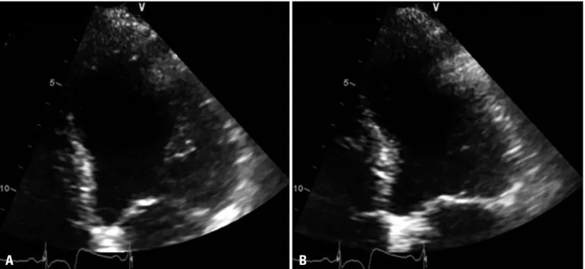 Fig. 1. The echocardiogram performed at admission reveals akinesis at the apex of LV and LV ejection fraction of less than 30%