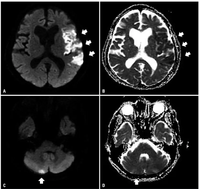 Fig. 1. Diffusion weighted (A and C) and apparent diffusion coefficient (B and D) brain magnetic resonance imaging show acute cerebral infarction in  the left middle cerebral artery territory (A and B, arrow) and right posterior inferior cerebellar artery 