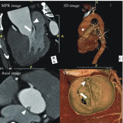 Fig. 4. The 640-slice cardiac computed tomography shows ascending  aortic aneurysm (*) and thickened unicuspid valve (arrow) with eccentric  unicommissural orifice (arrow head) in diastole