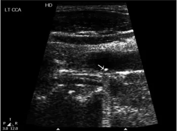 Fig. 1. A Duplex ultrasound six months after the injury depicts the  subintimal pellet in the initial position with an acoustic shadow.