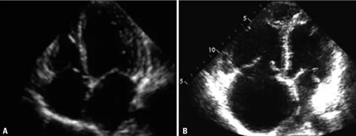 Fig. 1. A: Apical four-chamber view. Normal right-sided chambers: the  right ventricle is less than one third of the size of the left ventricle