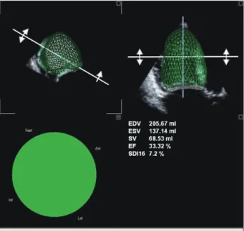 Fig. 4. Calculation of right ventricle volumes and ejection fraction with  3D echocardiography.