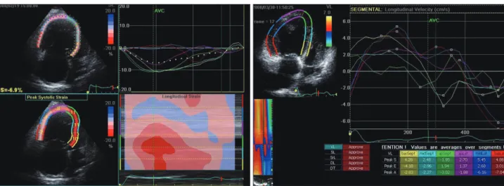 Fig. 5. Right ventricle speckle tracking.