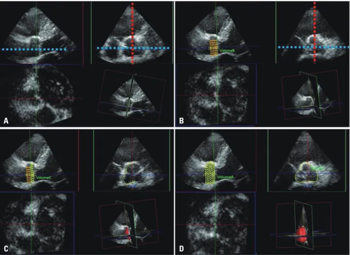 Fig. 2. Off-line analysis for quantification of the aortic root volume by 3-dimensional echocardiography