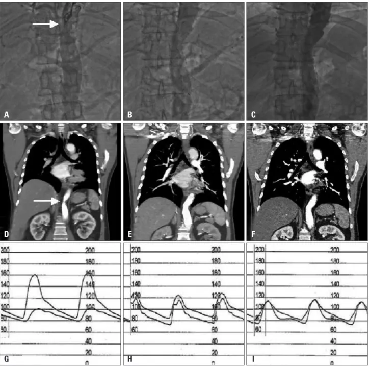 Fig. 2. Aortogram before stenting revealed significant luminal narrowing (arrow) at distal thoracic aorta (A), and after stenting (B) and 6 months follow- follow-up after stenting (C) revealed remarkable improvement of luminal narrowing in the distal thora
