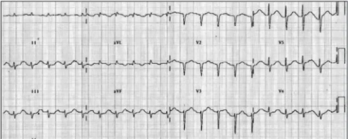 Fig. 1. An electrocardiogram showing an abnormal Q wave in the  anterior precordial leads and a prolonged QT interval.