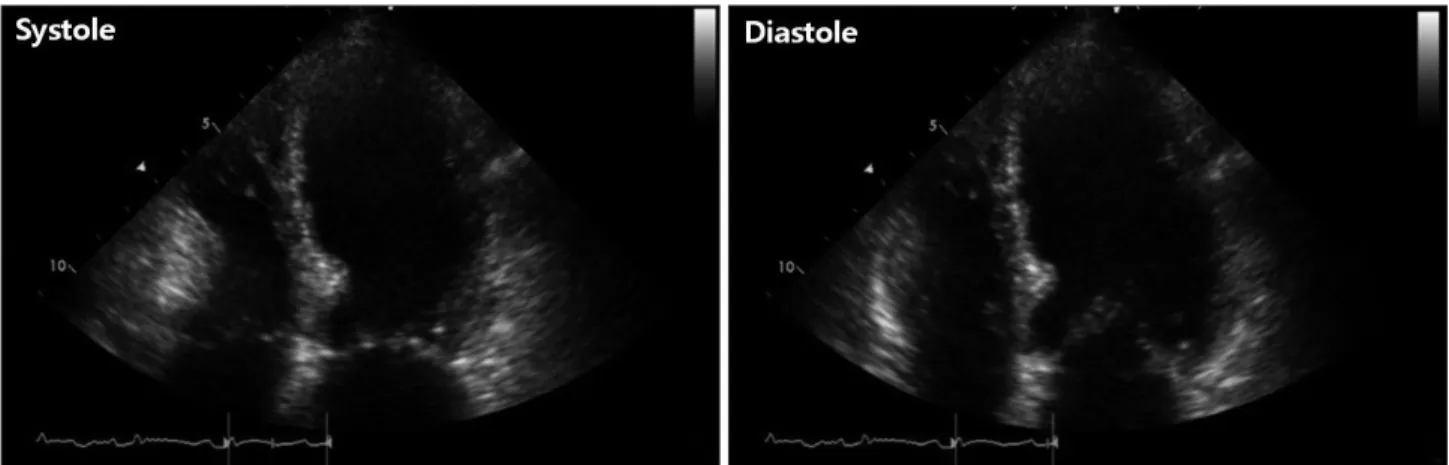 Fig. 2. Initial transthoracic echocardiographic image in the apical 4-chamber view showing left ventricular apical ballooning and dyskinesis.