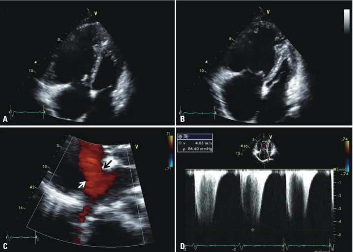 Fig. 1. The transthoracic echocardiogram shows markedly dilated right ventricle and dysfunction (A) end-diastole, and (B) end-systole