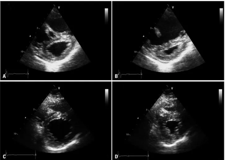 Fig. 2. The initial echocardiography reveals D-shaped left ventricle (A) end-diastole, and (B) end-systole