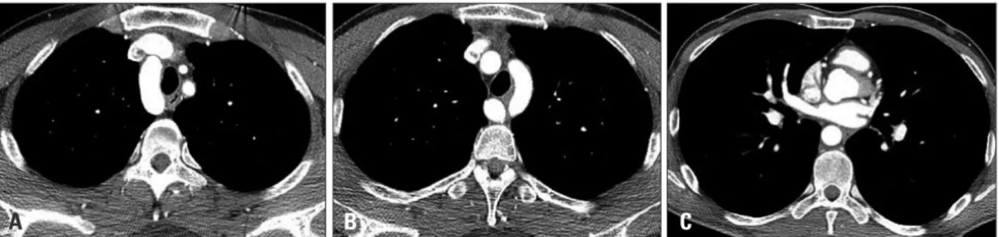 Fig. 3. Chest computed tomography showed double aortic arch. Right aortic arch (A) and left aortic arch (B) can be seen and both aortic arches fuse  into descending aorta located in front of the spine (C)