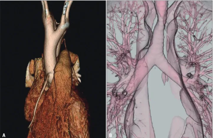 Fig. 4. Reconstructed images of chest computed tomography showed balanced type double aortic arch (A) with only slight compression of the  trachea (B)