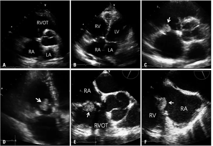 Fig. 4. A and B: Parasternal short axis view and apical four-chamber view. There was no visible mass in the immediate postoperative image