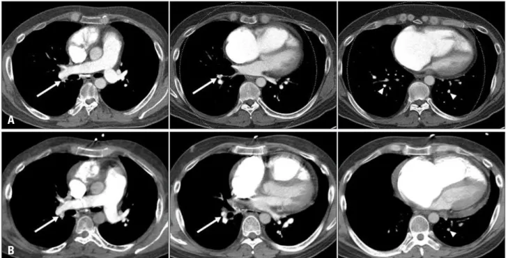 Fig. 1. A: Baseline computed tomographic pulmonary angiography (CTPA) performed 7 weeks before the index visit to emergency department (ED)