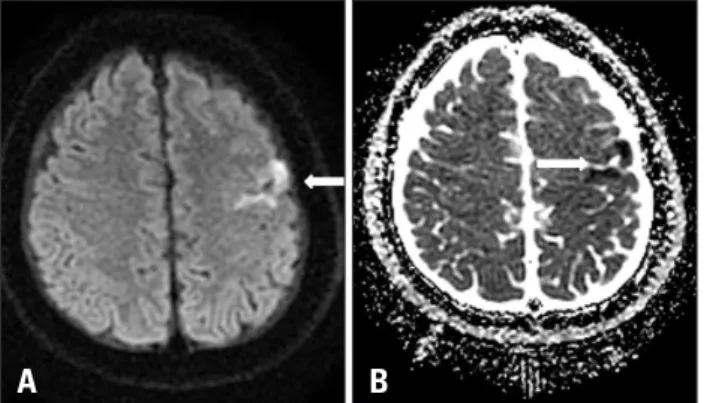Fig. 1. Brain magnetic resonance imaging. High signal intensity lesion  on diffusion weighted imaging (A) with decreased signal intensity on  apparent diffusion coefficient value at left precentral gyrus (B) was  observed which indicates hyperacute infarct