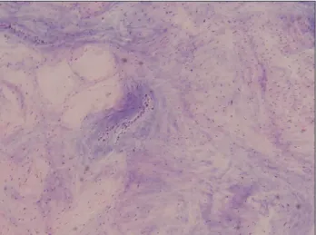 Fig. 4. Histologic examination showed spindle-shaped cells and  stellate cells in a myxoid stroma (H&amp;E stain, × 100).