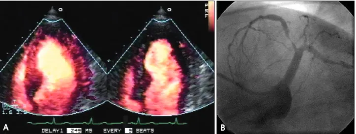 Fig. 1. Myocardial contrast echocardiography using power harmonic Doppler imaging with a dual-frame triggering (A)