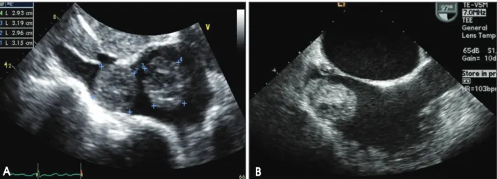 Fig. 3. A chest computed tomogram reveals two well-defined masses in the right atrium and inferior vena cava (arrows).