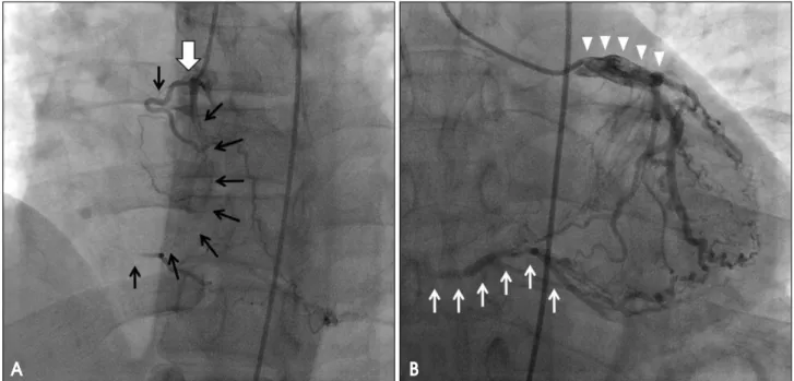 Fig. 4. Serial two-dimensional echocardiography images. Comparing with preoperative status (A), postoperative echocardiography (B) showed that a substantial volume of hematoma (H, hematoma) still remained