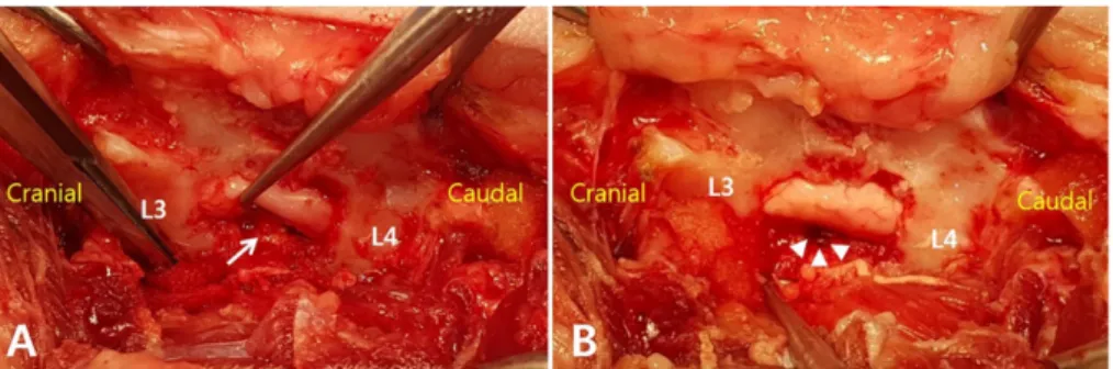 Fig. 3. Schematic diagram showing the process of mini-partial lateral corpectomy (PLC) performed after hemilaminectomy: transverse view of intervertebral disc space