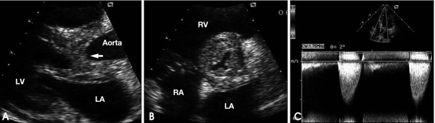 Fig. 2. Aortic valve (AV) long axis view demonstrates severe swelling of aortic root (arrows) and periaortic apparatus more clearly (A)