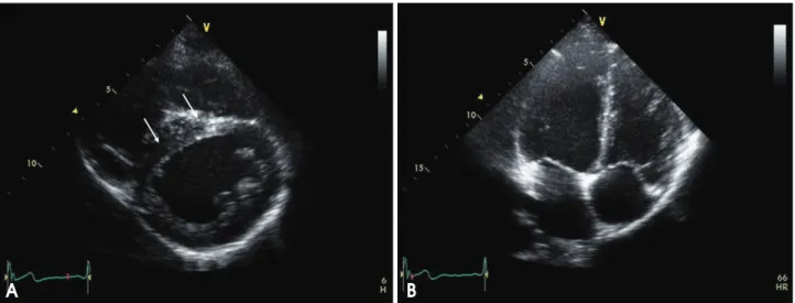 Fig. 2. Doppler findings. A: PAsP from TRV was within normal range. B: RVOT AT was 88.7 msec and calculated mPAP from the simplified Mahan’s equation (mPAP= 80-[RVOT AT×0.5]) was 35.6 mmHg (B)