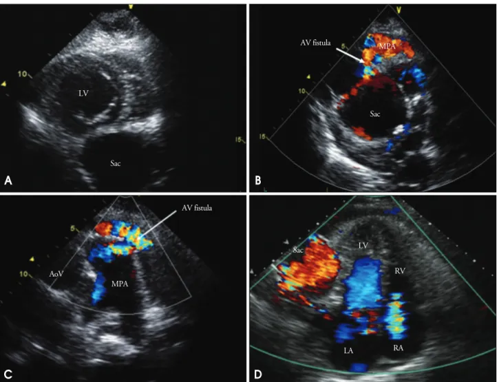 Fig. 1. A: Echocardiogram in parasternal short axis view show extrinsic cardiac compression in left ventricle side due to multiple fusiform aneurysms (maximal diameter of largest one: about 6.7 cm)