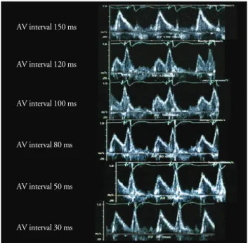 Fig. 2. Doppler echocardiographic finding of mitral flow velocity in different atrioventricular interval