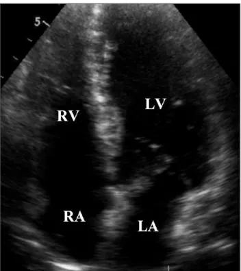 Fig. 4. A final echocardiogram at eight weeks after percutaneous coronary intervention shows a complete resolution of the hematoma