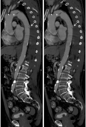 Fig. 1. The chest CT with sagittal reconstruction. The proximal dissection (*). The distal dissection (arrow).