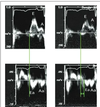 Fig. 4.  Mitral inflow and TD signals at baseline and after circumflex occlusion from one of the canine experiments