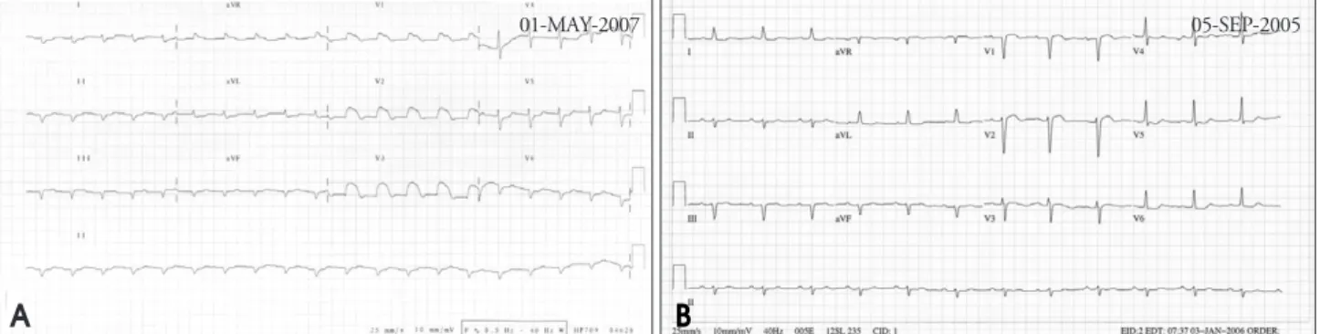Fig. 1. A: Initial electrocardiogram showed low voltage, Q waves in inferior leads and ST-segment elevation in the leads V1 to V3