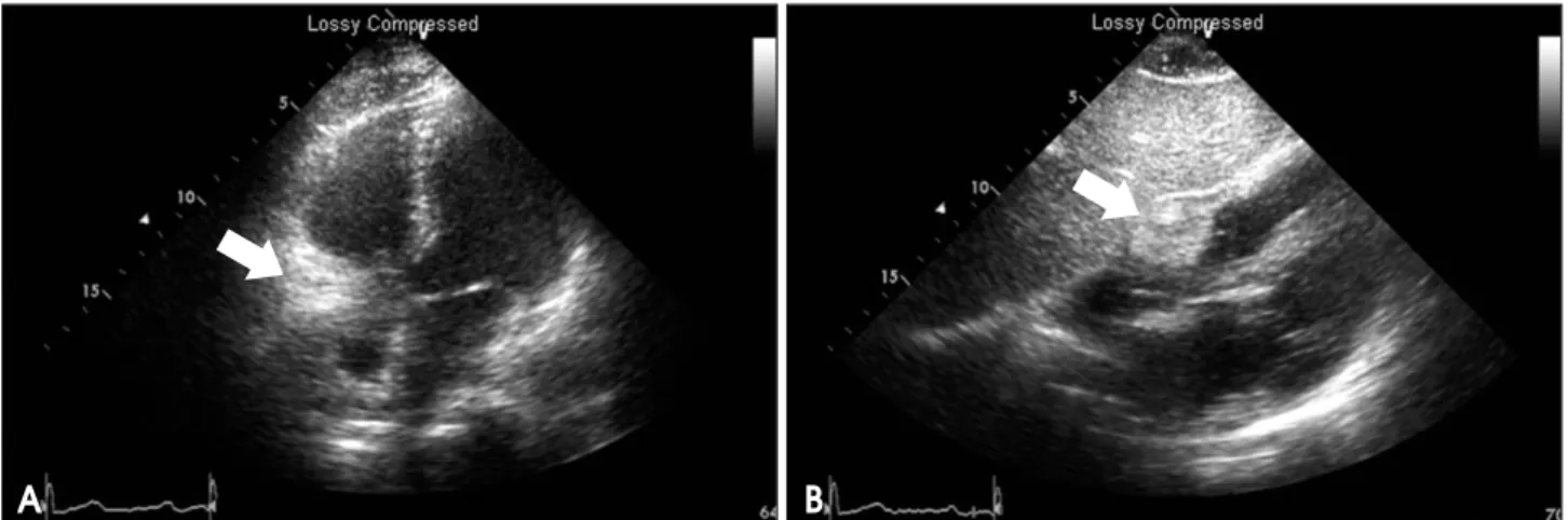 Fig. 3. Transthoracic echocardiography performed on 12 days after percutaneous coronary intervention