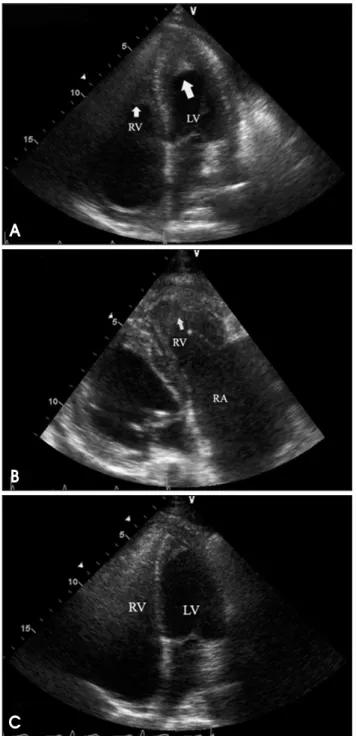 Fig. 1. Apical 4 chamber view of initial echocardiography showed apical homogeneous materials (arrows) suggestive of thrombi in the both ventricles (A)