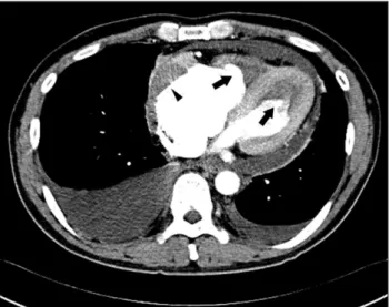 Fig. 2. Computerized tomography of the chest showed apical obliterations of both ventricles by non-enhanced homogenous materials (arrow) consistent with the echocardiographic findings