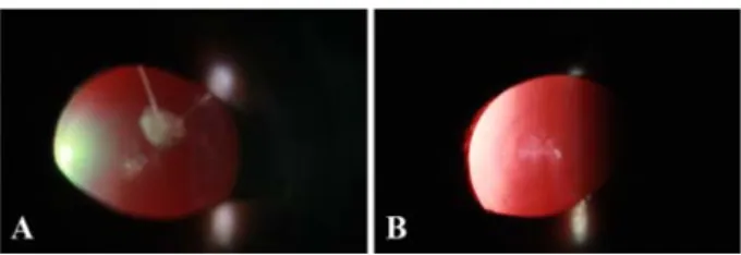 Fig. 2. Posterior capsular cataracts seen with retro-illumination by slit-lamp biomicroscopy in both eyes (A, right eye; B, left eye).