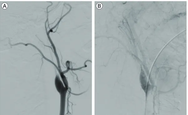 Fig. 1. Right CCA DSA lateral view. (A) Early arterial phase of the right CCA. (B) Late arterial phase of the right CCA