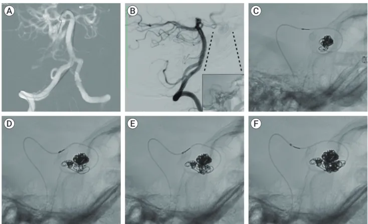 Fig. 3. Right vertebral artery DSA during the treatment. (A) Right vertebral artery roadmap (frontal view) with the microcatheter navigation  throw the Pcom artery to achieve the fistular point