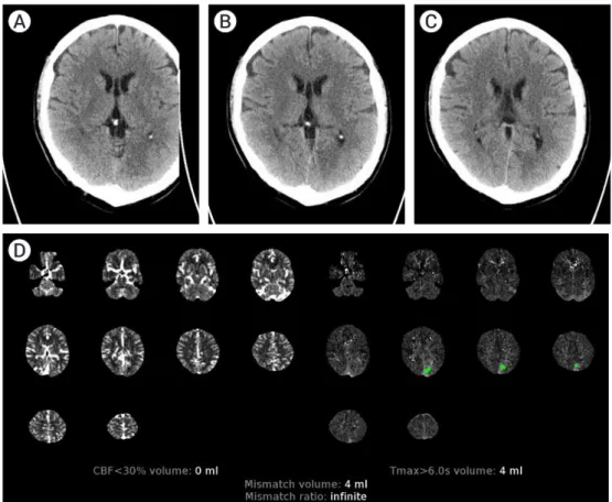 Fig. 2. Demonstration of core infarct discrepancy in patient 5. Axial non-contrast computed tomography (CT) head images (A, B, C) show  hypodensity in the left occipital lobe in the distribution of the left posterior cerebral artery